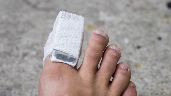 Bruten tå: orsak, symtom & behandling